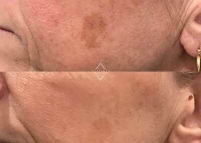 BBL before and after photo from NEOskin Center in Ohio