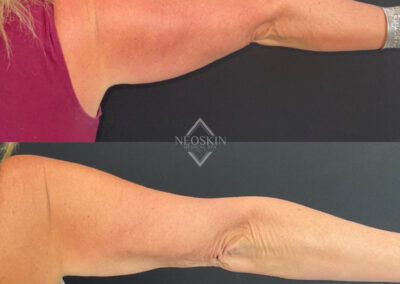 Before & After image of arms with Coolsculpting from NEOskin Center Ohio