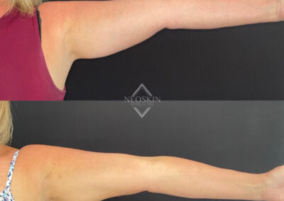 Before & After image of arms with Coolsculpting from NEOskin Center Ohio