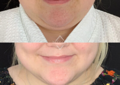 Before & After image of chin with Coolsculpting from NEOskin Center Ohio