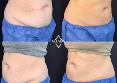 Before & After image of stomach with Coolsculpting from NEOskin Center Ohio