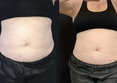 Before & After image of stomach with Coolsculpting from NEOskin Center Ohio