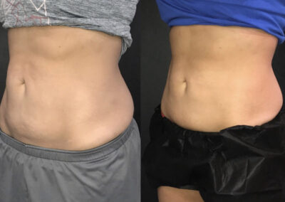 Before & After image of stomach with Coolsculpting from NEOskin Center Ohio