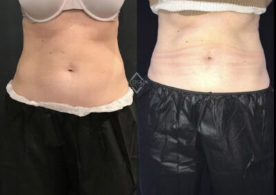 Before & After image of stomach with Coolsculpting from NEOskin Center Ohio