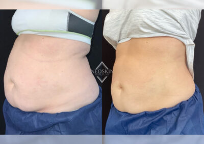 Before & After image of stomach with Coolsculpting from NEOskin Center Ohio