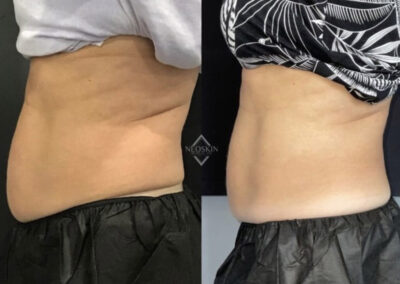 Before & After image of stomach with Coolsculpting from NEOskin Center Ohio