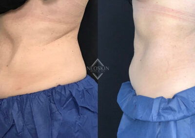 Before & After image of stomach with Coolsculpting from NEOskin Center Ohio