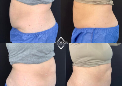 Before & After image of stomach with Coolsculpting from NEOskin Center Ohio