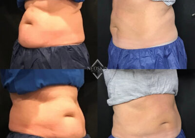 Before & After image of stomach with Coolsculpting from NEOskin Center Ohio