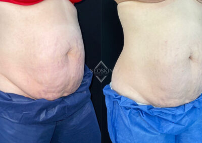 Before & After image of stomach with Coolsculpting from NEOskin Center Ohio