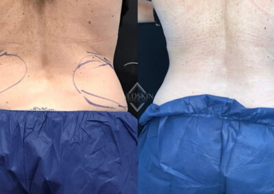 Before & After image of Waistline with Coolsculpting from NEOskin Center Ohio