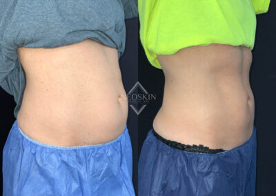 Before & After image of Waistline with Coolsculpting from NEOskin Center Ohio