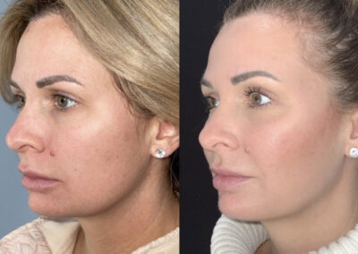 Emface & Exilis before & after image of women's face from NEOskin Center Ohio