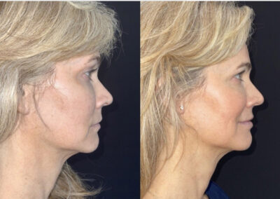 Emface & Exilis before & after image of women's face from NEOskin Center Ohio