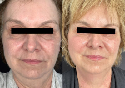 Emface & Exilis before & after image of women's face from NEOskin Center Ohio