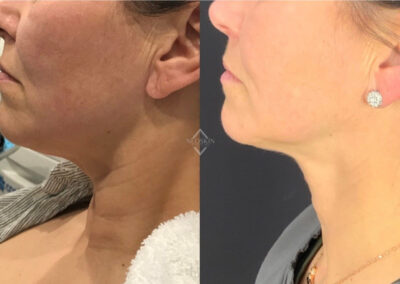 Emface & Exilis before & after image of women's neckline from NEOskin Center Ohio