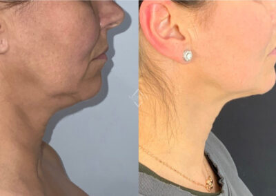 Emface & Exilis before & after image of women's neckline from NEOskin Center Ohio