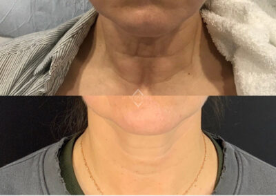 Emface & Exilis before & after image of women's neckline from NEOskin Center Ohio