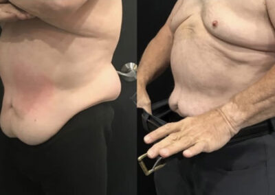 Emsculpt & Emtone abdomen before & after image from NEOskin Center Ohio