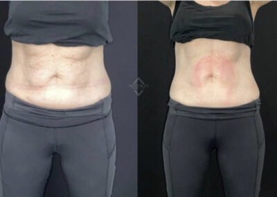 Emsculpt & Emtone abdomen before & after image from NEOskin Center Ohio