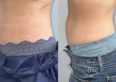 Emsculpt & Emtone abdomen before & after image from NEOskin Center Ohio