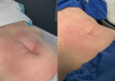 Emsculpt & Emtone abdomen before & after image from NEOskin Center Ohio