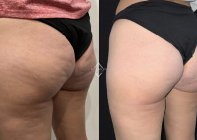 Emsculpt & Emtone buttocks before & after image from NEOskin Center Ohio