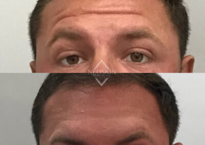 BOTOX Before & After Image of man's forehead from NEOskin Center Ohio