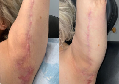 Microneedling before and after photo from NEOskin Center in Ohio