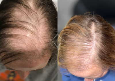 Microneedling PRP before and after photo from NEOskin Center in Ohio