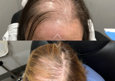 Microneedling PRP before and after photo from NEOskin Center in Ohio