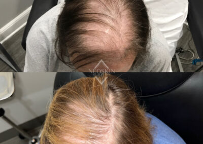 Microneedling PRP before and after photo from NEOskin Center in Ohio