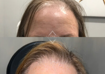 Microneedling PRP before and after photo from NEOskin Center in Ohio