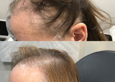 Microneedling PRP before and after photo from NEOskin Center in Ohio