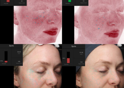 Moxi before and after photo from NEOskin Center in Ohio