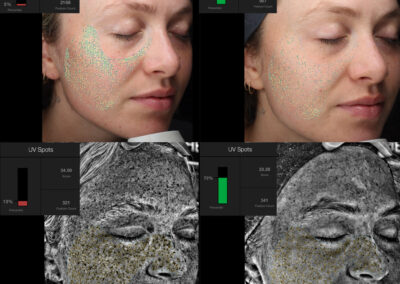 Moxi before and after photo from NEOskin Center in Ohio