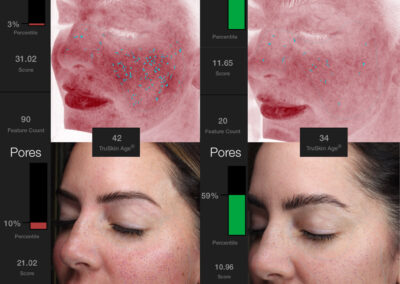 Moxi before and after photo from NEOskin Center in Ohio