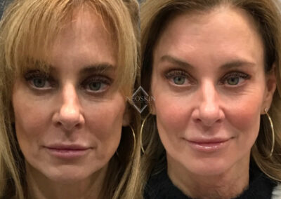 Sculptra before and after photo from NEOskin Center in Ohio