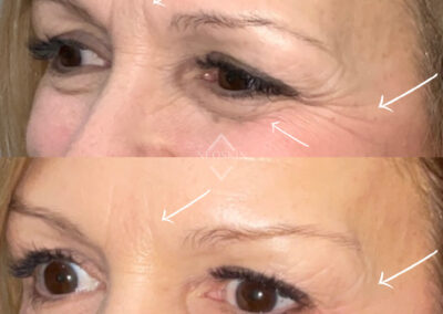 BOTOX Before & After Image of woman's crow's feet from NEOskin Center Ohio