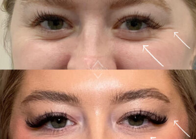 BOTOX Before & After Image of woman's eyes from NEOskin Center Ohio