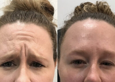 BOTOX Before & After Image of woman's forehead from NEOskin Center Ohio