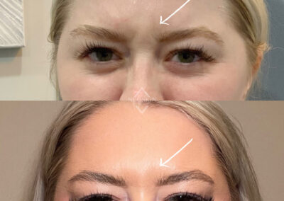 BOTOX Before & After Image of woman's forehead from NEOskin Center Ohio