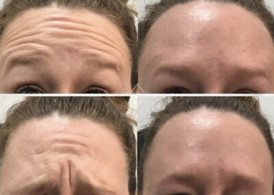 BOTOX Before & After Image of woman's forehead from NEOskin Center Ohio