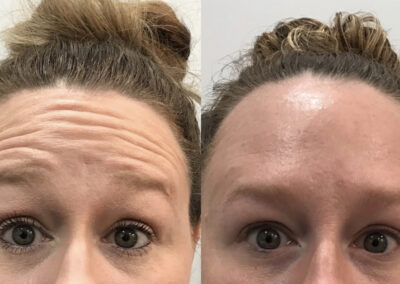 BOTOX Before & After Image of woman's forehead from NEOskin Center Ohio