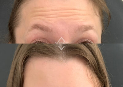 BOTOX Before & After Image of woman's forehead from NEOskin Center Ohio