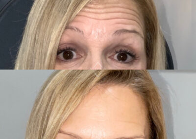 BOTOX Before & After Image of woman's forehead from NEOskin Center Ohio