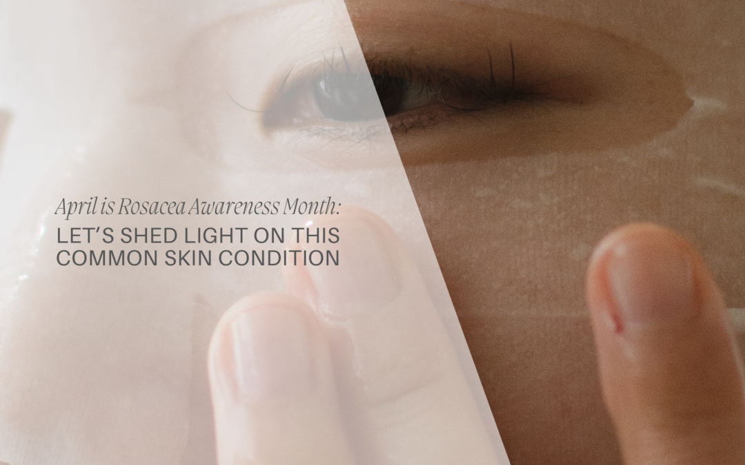 April is Rosacea Awareness Month – Let’s Shed Light on This Common Skin Condition
